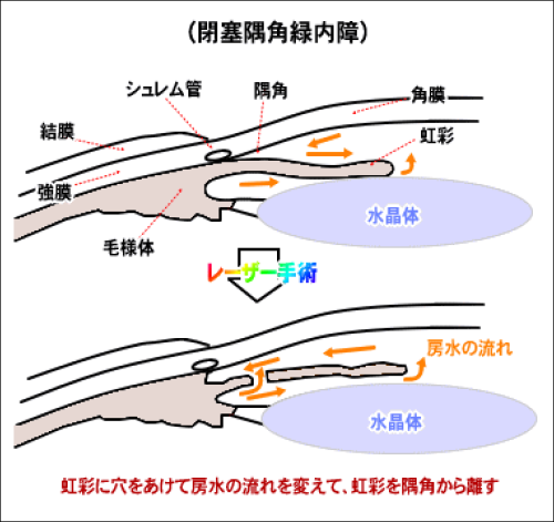 閉塞隅角緑内障