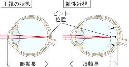 近視の構造